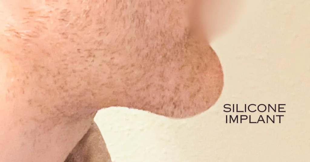 Chin Silicone implant – Design My Implants