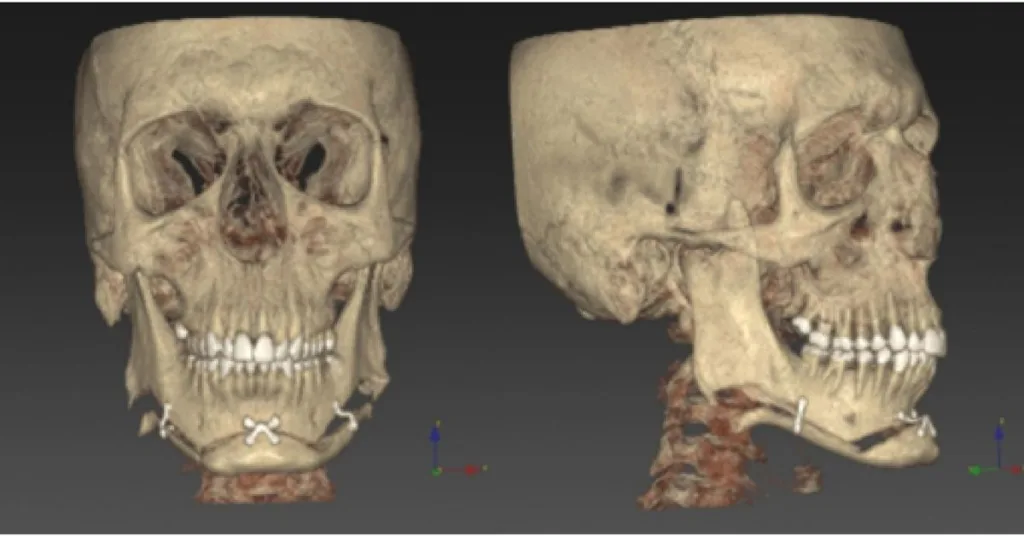 CHIN WING – Design My Implants