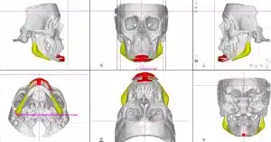 Genio implant – Design My Implants