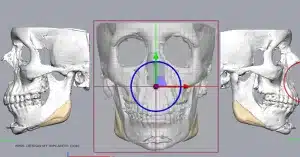 Design My Implants