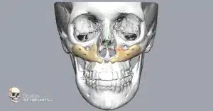 Cheek Implants – Design My Implants