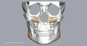 When Aesthetics Are Subjective: How Precision Planning Turns Opinion Into Symmetry – Design My Implants case study photo