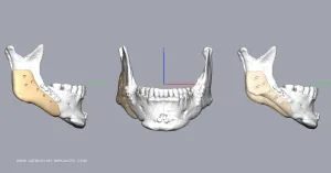Jaw Implant – Design My Implants