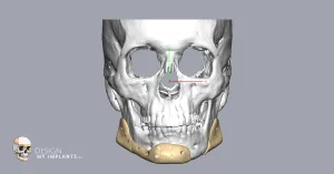 1Custom Chin & Jaw Implants – Design My Implants