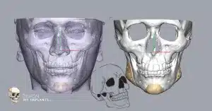 Jwa implants – Design My Implants