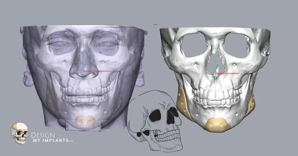 Jwa implants – Design My Implants