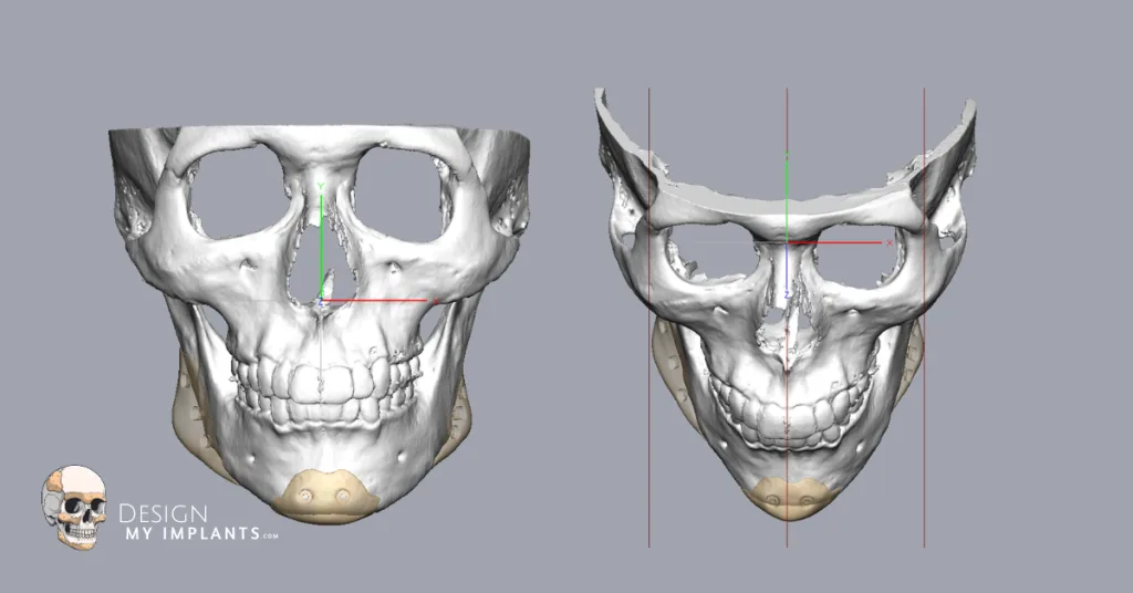 Chin Implant – Design My Implants