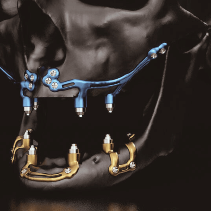 Design my implants Blue - yellow